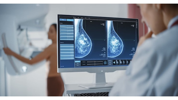 Tumore al seno, ecco perché la mammografia va anticipata in tutta Italia a partire dai 45 anni - Il Sole 24 ORE