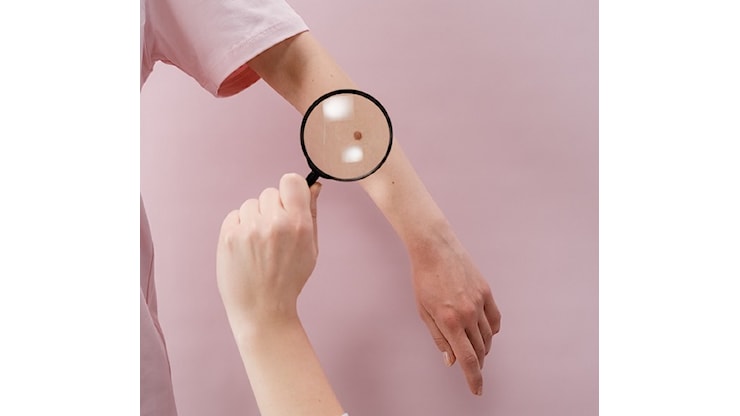 L’INT di Milano ridisegna i margini chirurgici del melanoma: meno bisturi, stessa guarigione - insalutenews.it