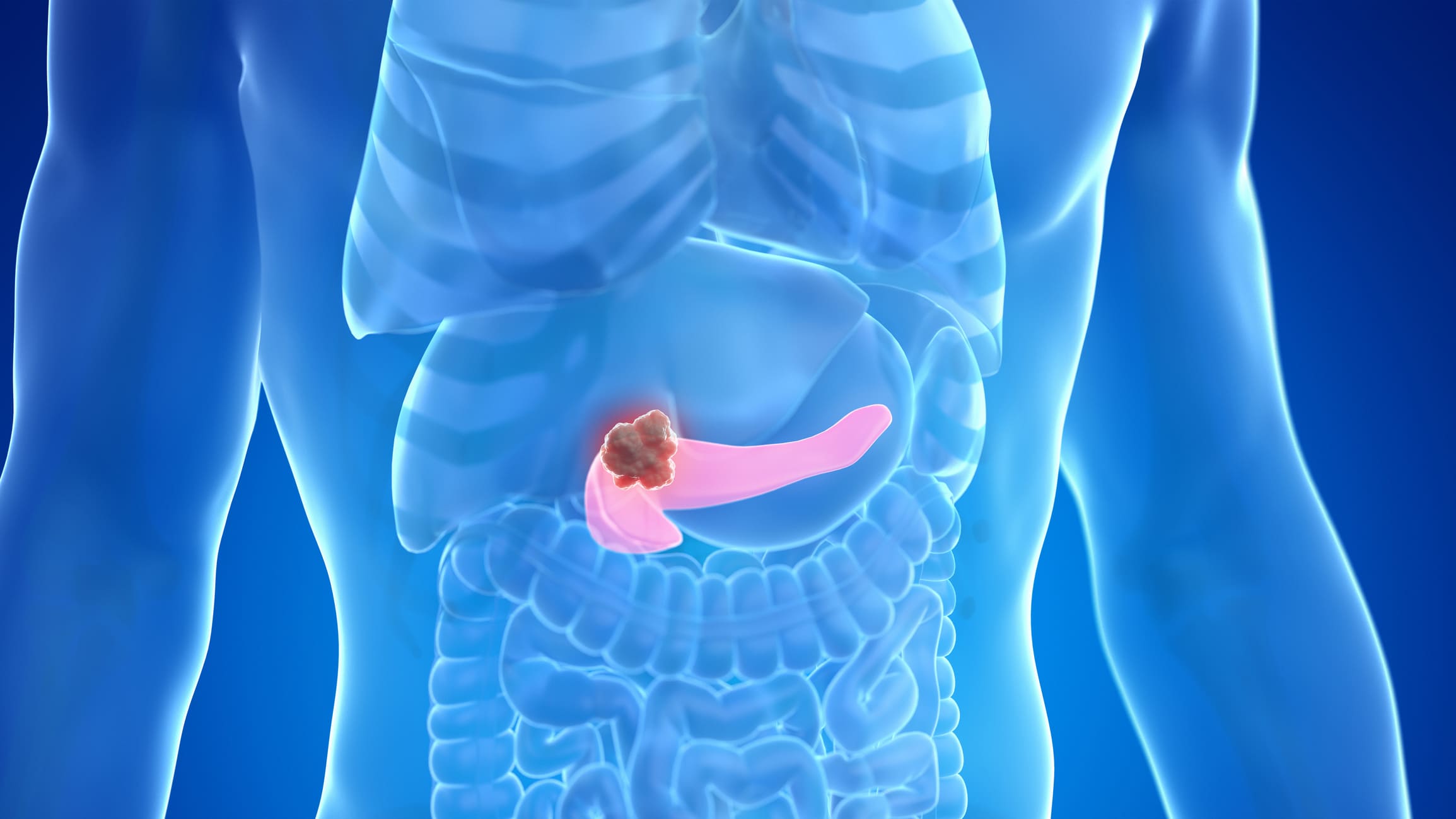 Tumore del pancreas: in futuro lo si potrà prevenire con un vaccino?